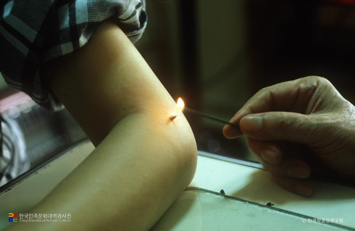 직접뜸 뜨는 모습